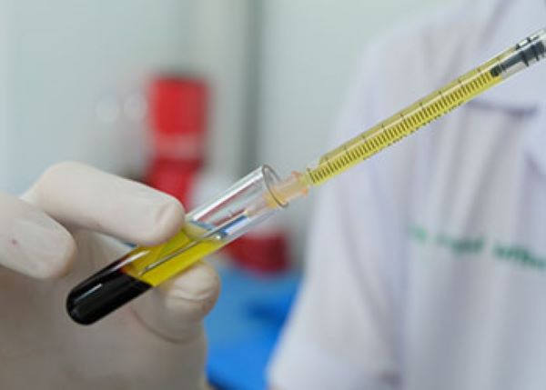 시험관에 담긴 혈액에서 주사기로 PRP를 추출하고 있는 사진