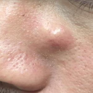 신경섬유종 초기 증상, 혹시 나도? 놓치면 안 되는 신호