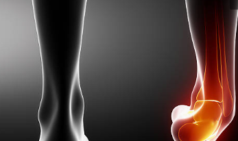 발목터널증후군 증상 말초신경 운동법 수술 및 치료 방법