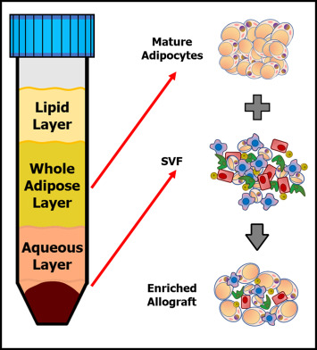 자가지방무릎줄기세포주사