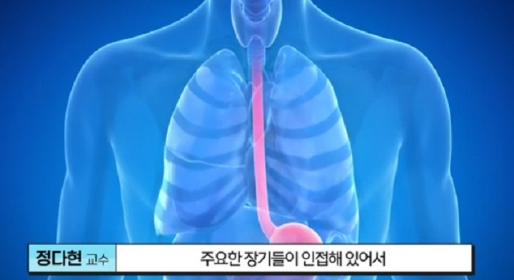 EBS명의-식도암-박종재-교수