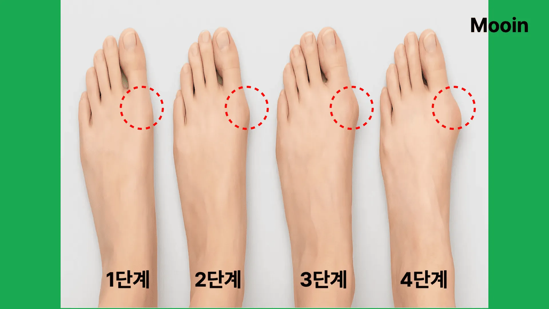 무지외반증 증상별 단계