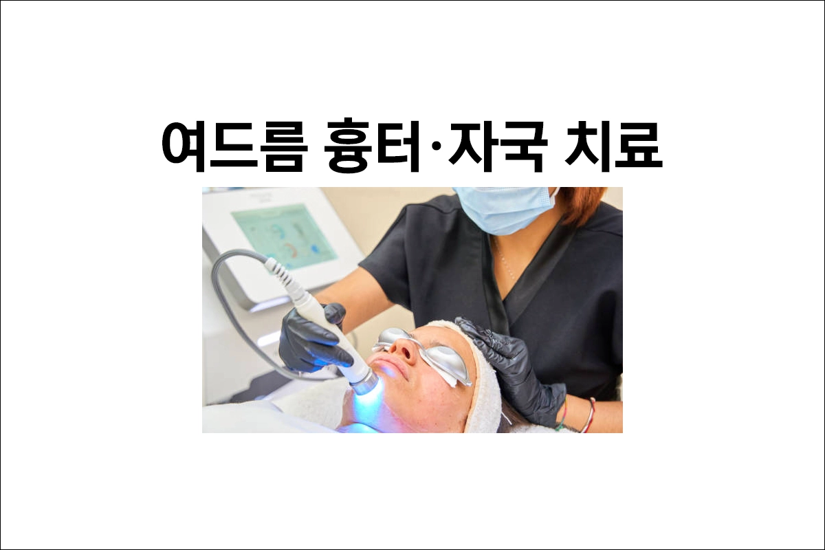 여드름 흉터 여드름 자국 치료 브이빔- 엘립스 I²PL PPT