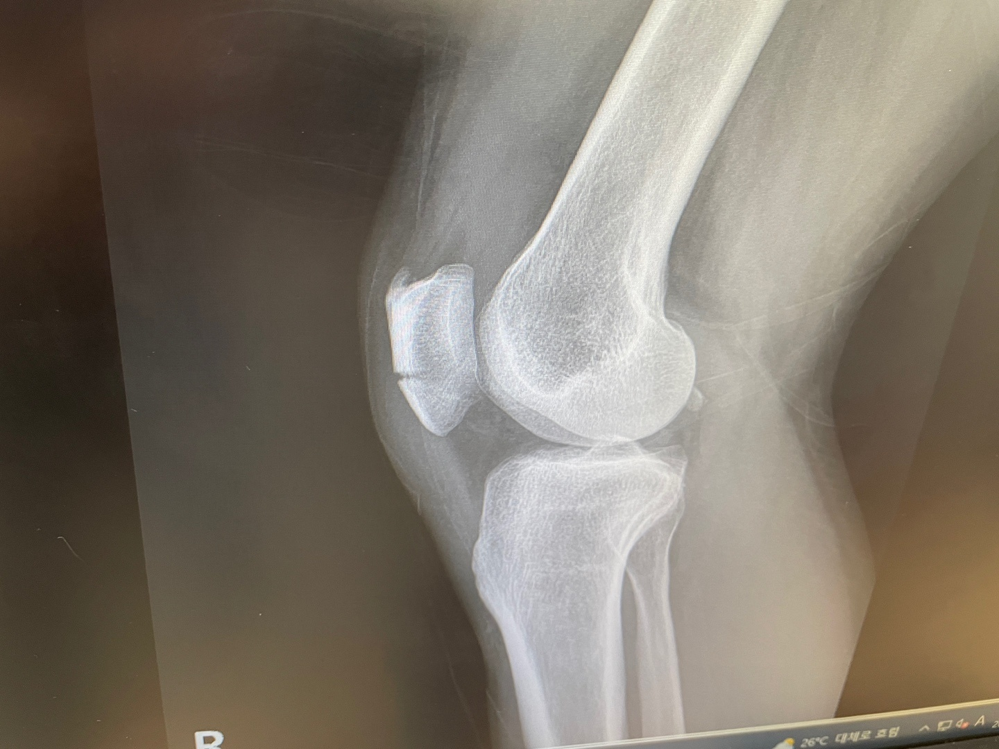 공유킥보드 교통사고로 촬영한 무릎 X-ray, 슬개골 골절 소견이 보이는 사진