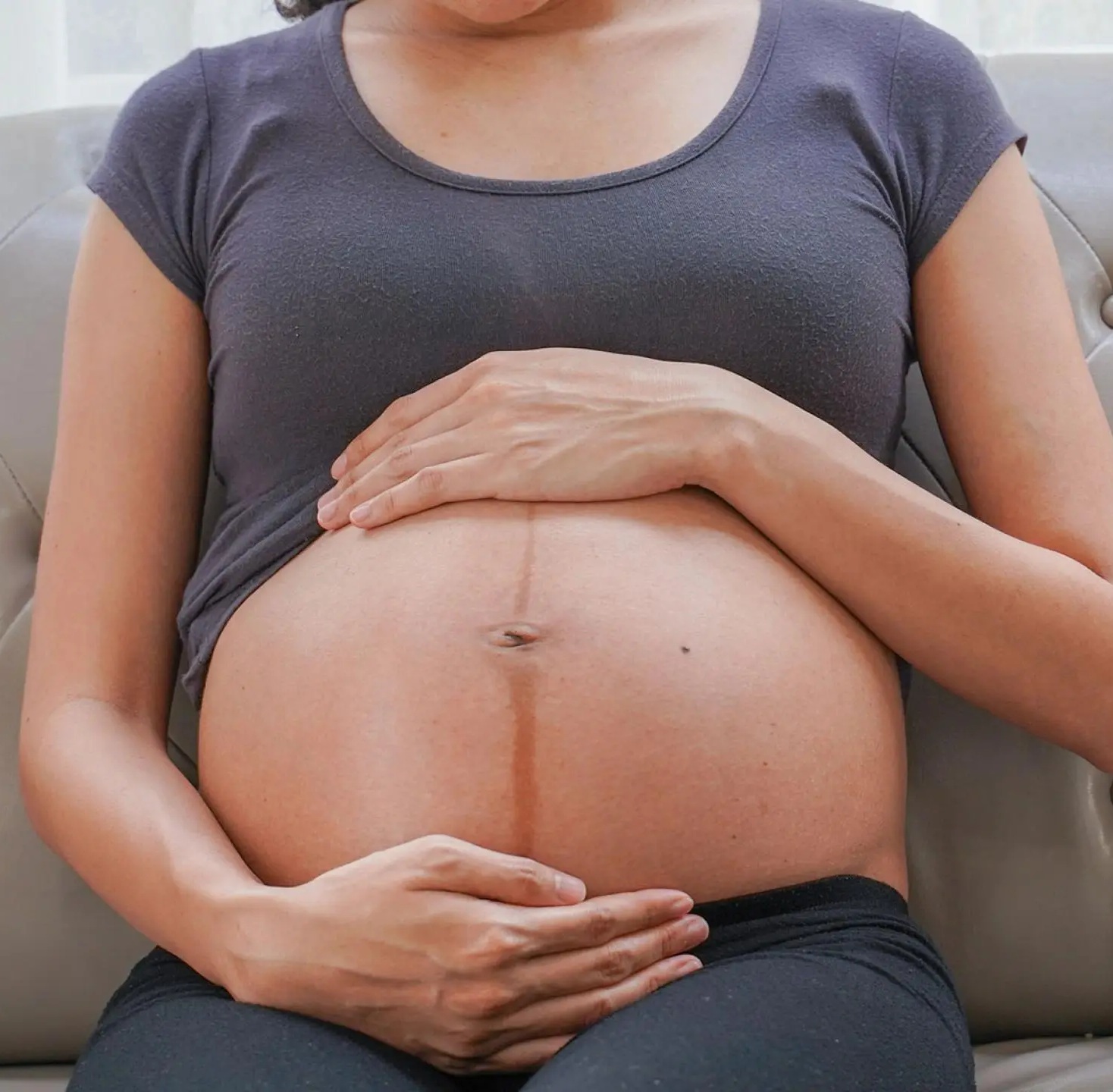 임신선없애는법