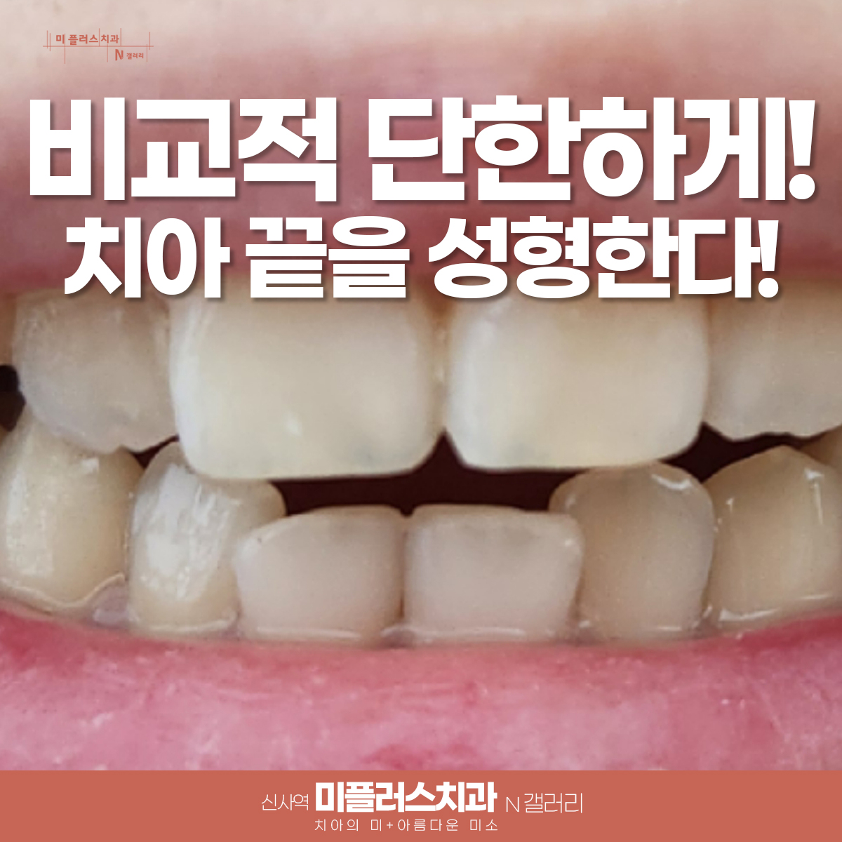 앞니 울퉁불퉁 에나멜플라스티 후