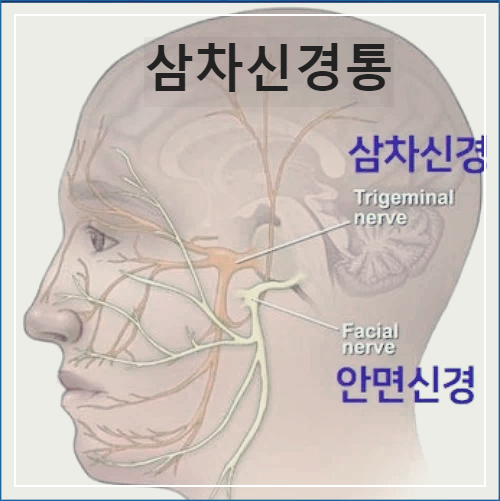 삼차신경통 증상