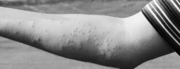 심리적 스트레스