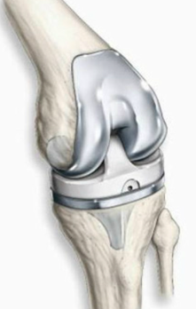 무릎의 인공관절