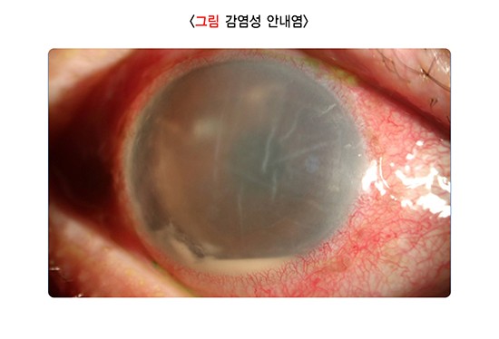 백내장