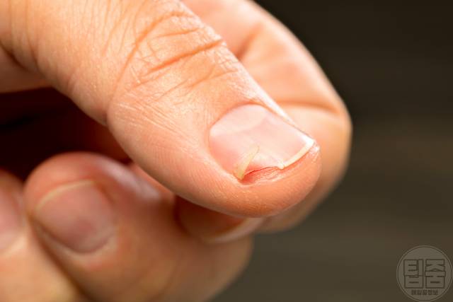 칼슘이 부족하면 나타나는 증상&#44;손톱 부러짐