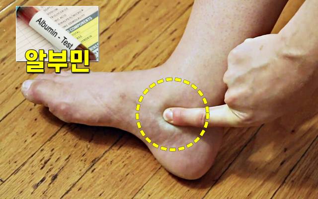 간이 안좋으면 나타나는 증상,발목 붓기,복수,간암 증상,간이안좋은증상,팁줌