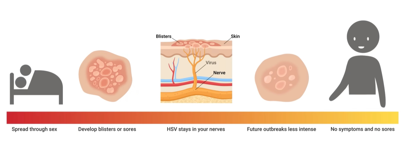 헤르페스 2형 증상