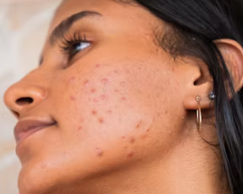 퀘르민과 여드름