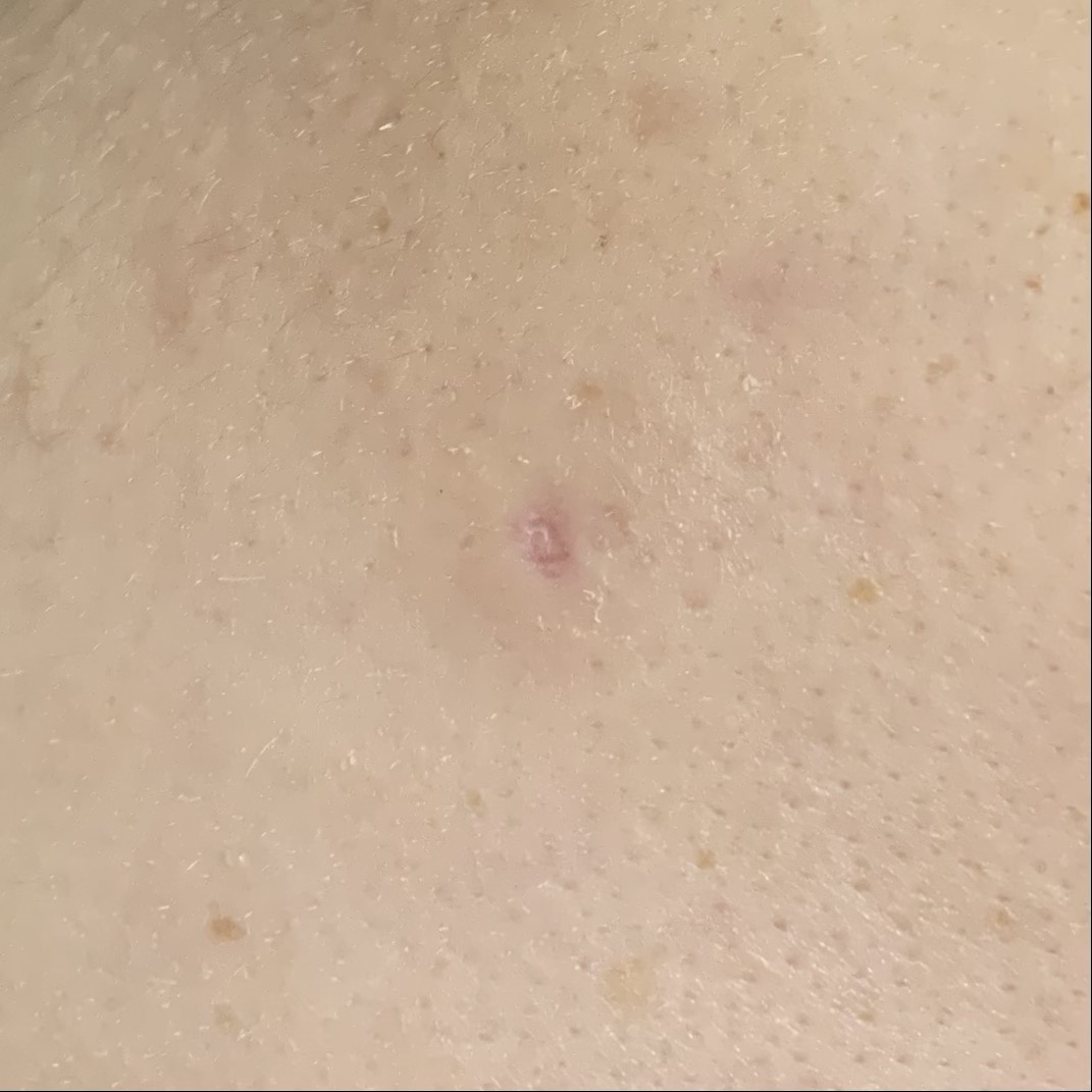 피지낭종 수술13일차