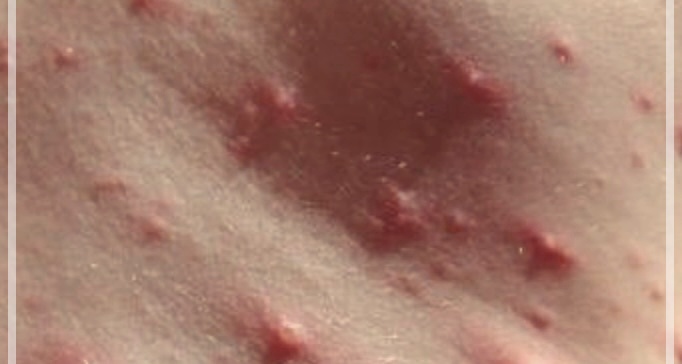 딸기혀 질병일명 가와사키병 원인 증상 치료에 모든 정보