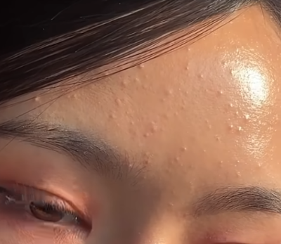 이마 뾰루지 없애는 법! 원인부터 해결 방법까지! (+ 2025년 최신 꿀팁)