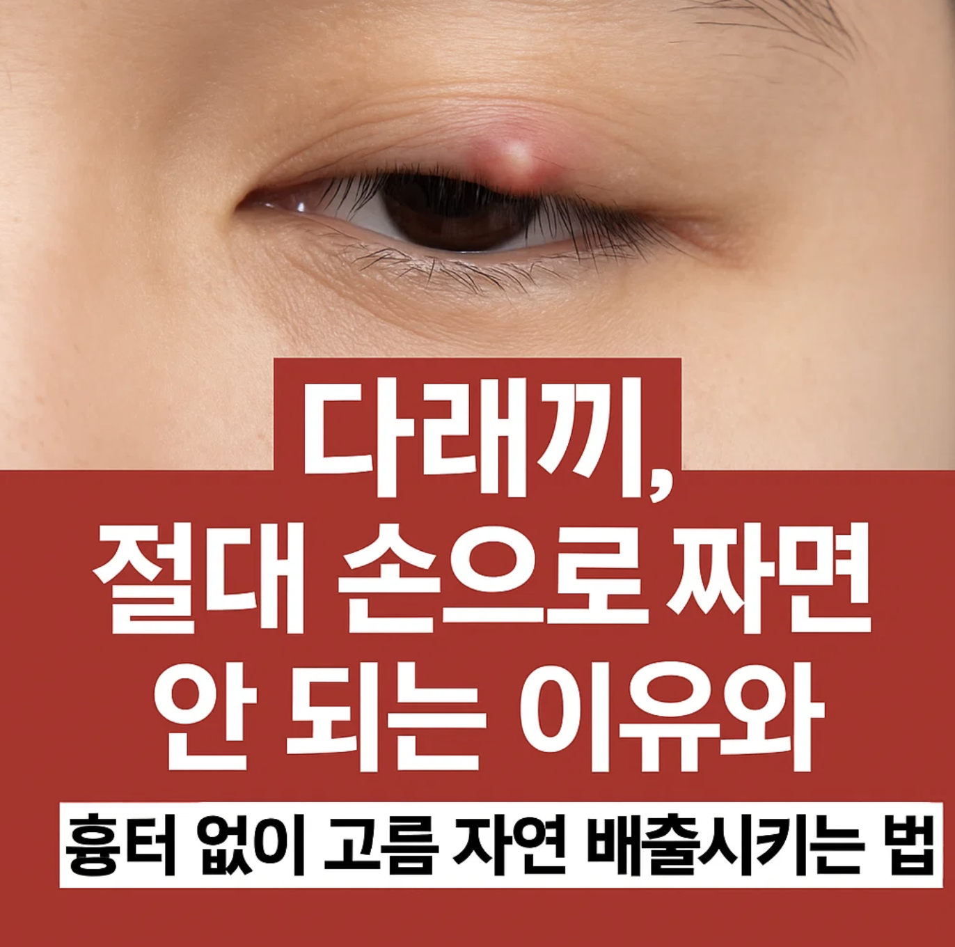 다래끼, 절대 손으로 짜면 안 되는 이유와 흉터 없이 고름 자연 배출시키는 법