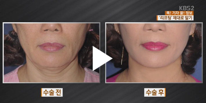 리프팅 효과 장면 - 출처 : KBS뉴스