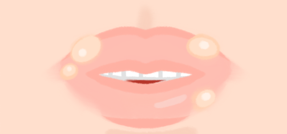 수포 형성 단계