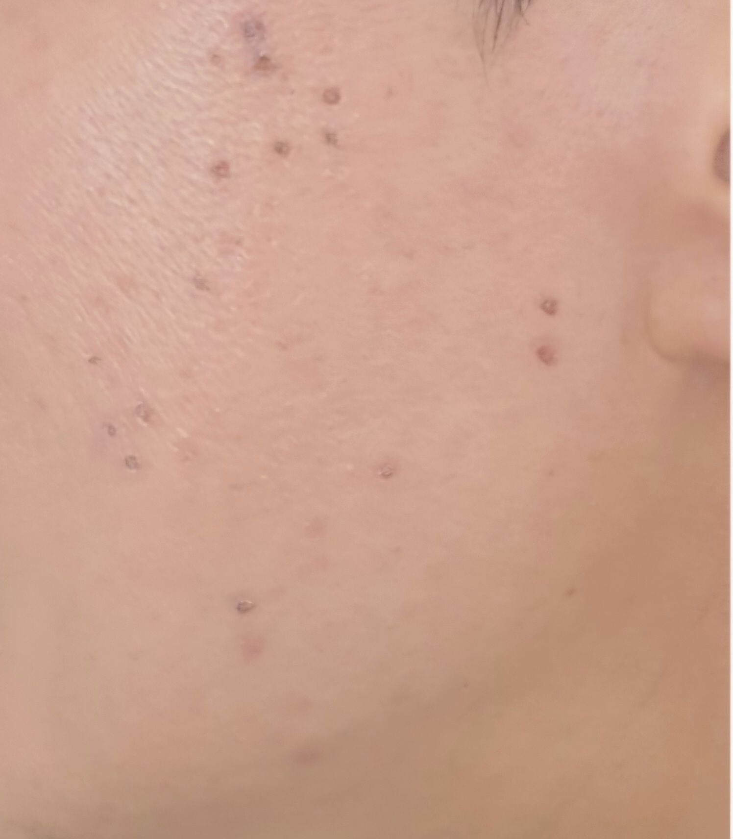 점뺀 5일후 사진