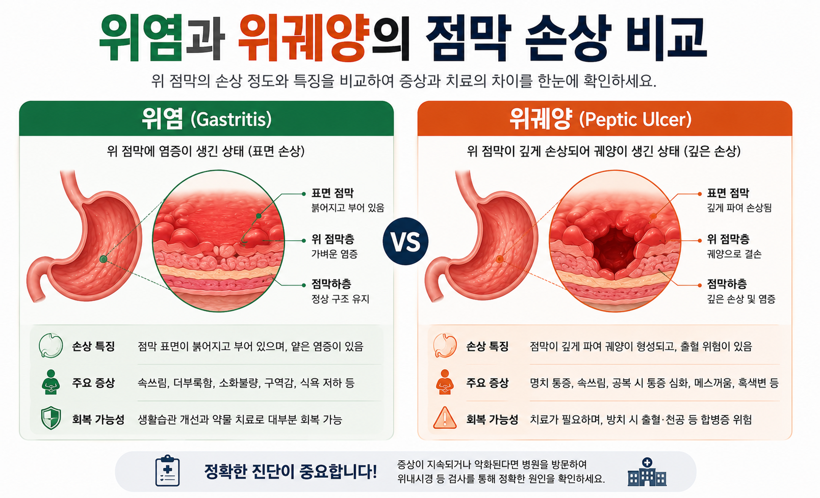위염과 위궤양의 점막 손상 깊이 비교 이미지