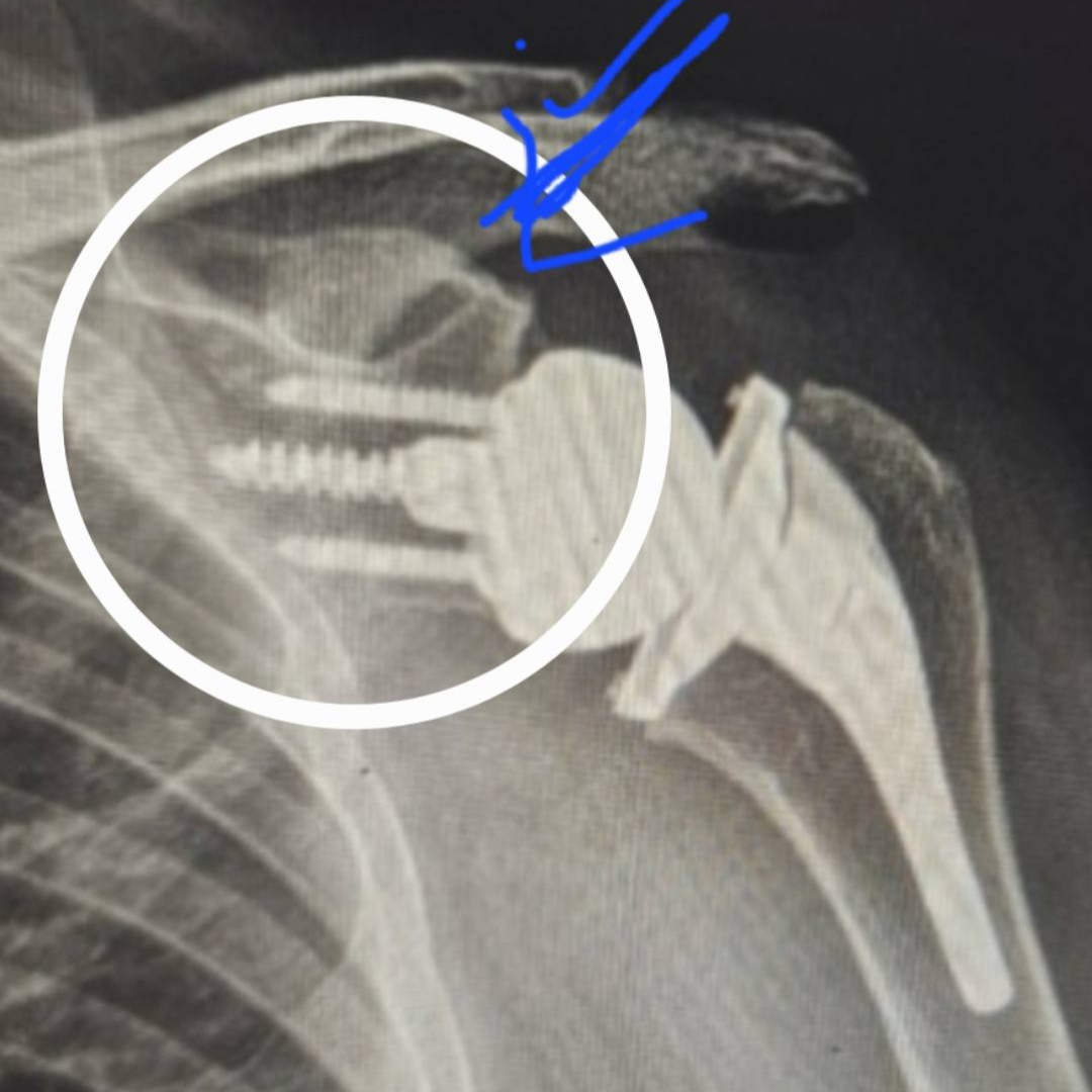 상완골 골절 핀 제거 시기