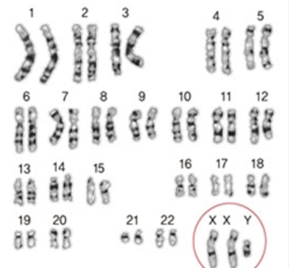클라인펠터 증후군