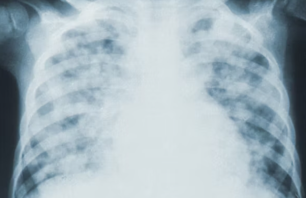 마이코플라즈마 폐렴