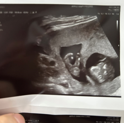 임신 12주 니프티(NIPT) 검사 비용, 후기