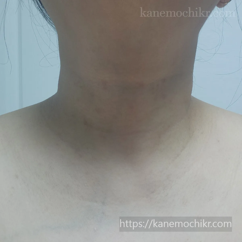 쥐젖-편평사마귀-제거12일차