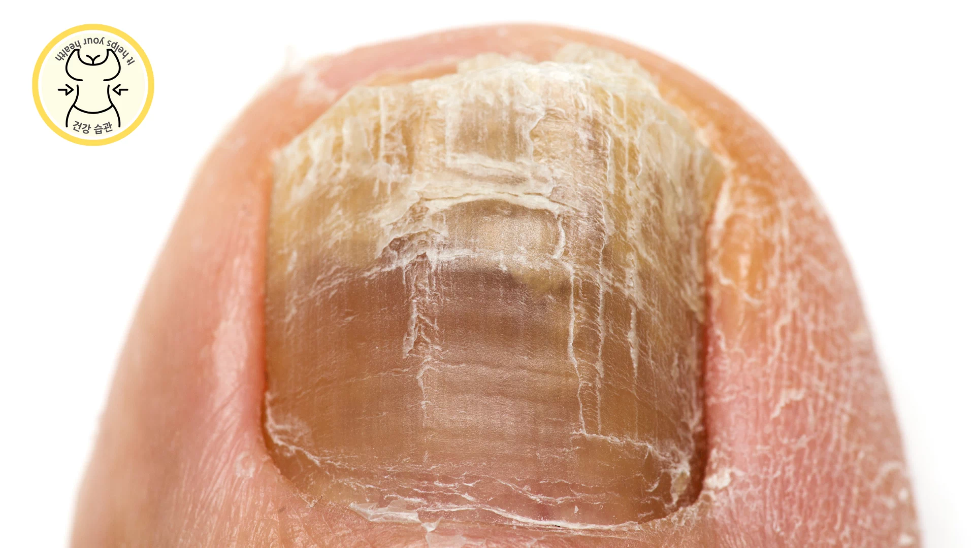 내성 발톱이 생기는 이유