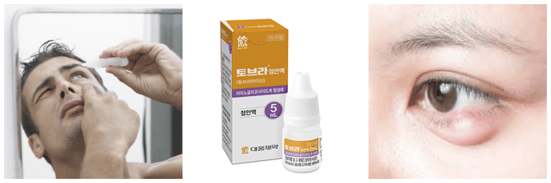 안약 넣는 사진, 토브라점안액, 다래끼 사진