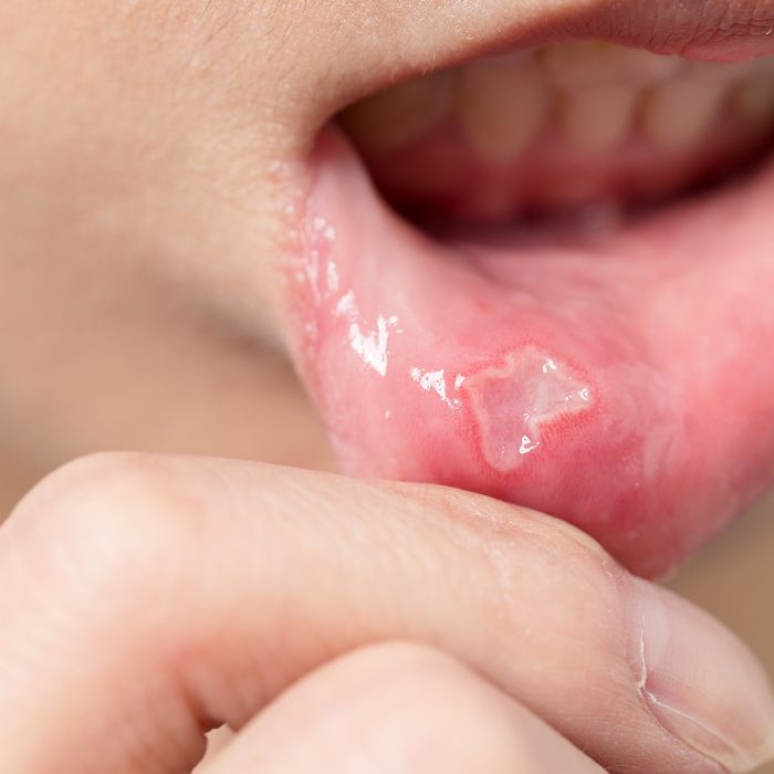 구내염 원인