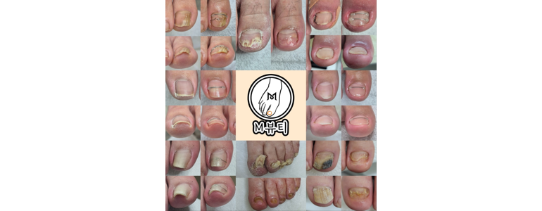 서울 강서구 내성발톱