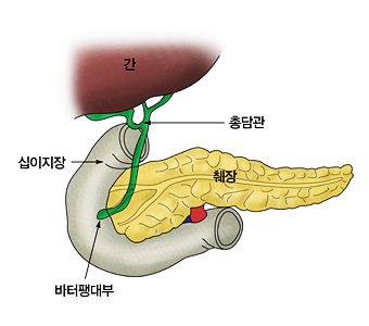 췌장염 초기증상