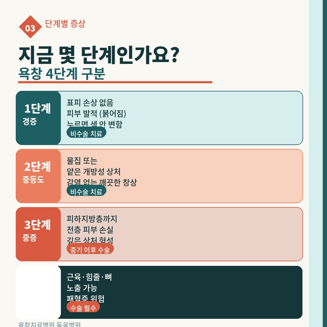 욕창의 4단계 구분을 설명하는 카드. 1단계 경증(발적), 2단계 중등도(물집·얕은 상처), 3단계 중증(피하지방층 손실), 4단계(근육·뼈 노출, 패혈증 위험). 단계별 비수술/수술 치료 여부 표시.
키워드: 욕창 단계, 욕창 4단계, 욕창 증상, 욕창 단계별 증상, 욕창 진행
