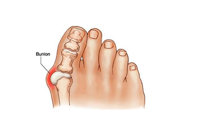 무지외반증관련사진