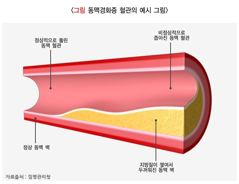 협심증 초기 증상, 치료, 검사 진단, 약, 원인, 예방
