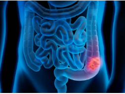 대장암 치료 전략