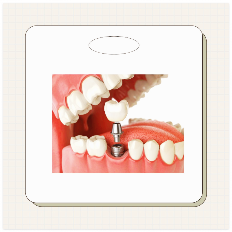 대전 임플란트 지원금