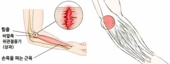 팔꿈치 통증 원인 6가지증상운동법예방법치료법까지_19