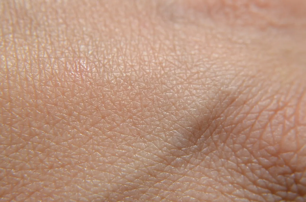 쥐젖. 물사마귀