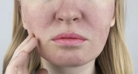 모낭염 원인과 치료방법