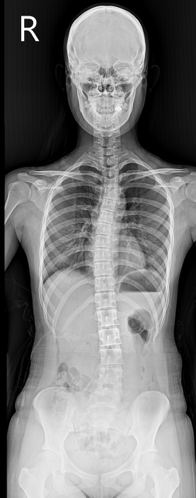 whole spine 검사