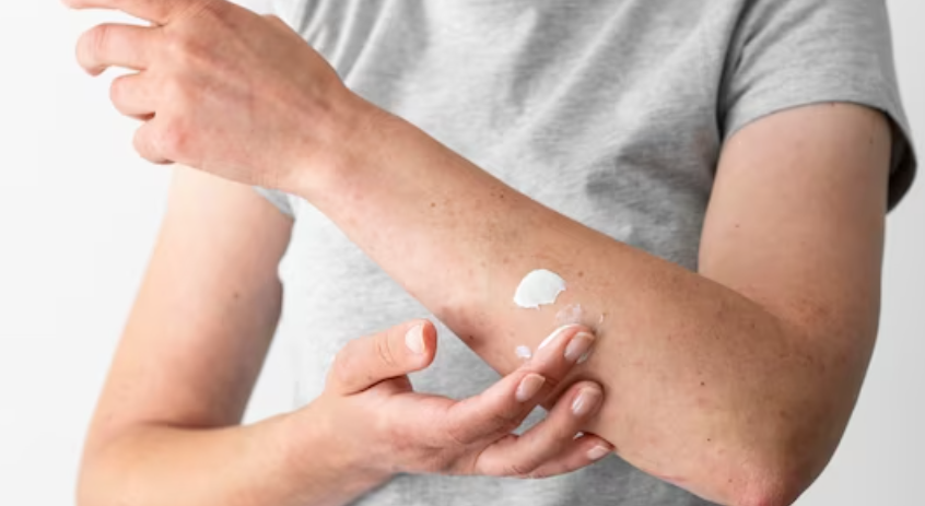 땀띠 치료에 따른 주의 사항