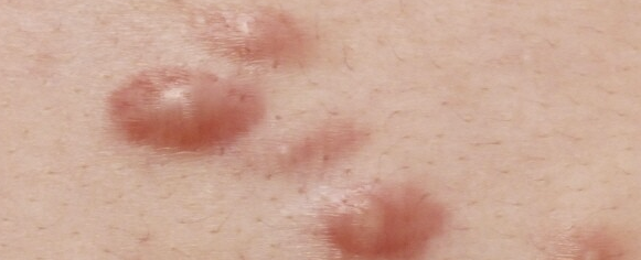 켈로이드 주사2