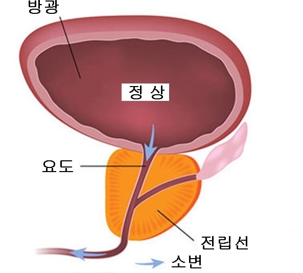 전립선 비대증