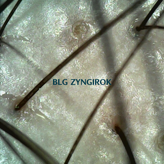 탈모 극복 프로젝트 - 정수리와 이마 사이 두피 모습이다.
