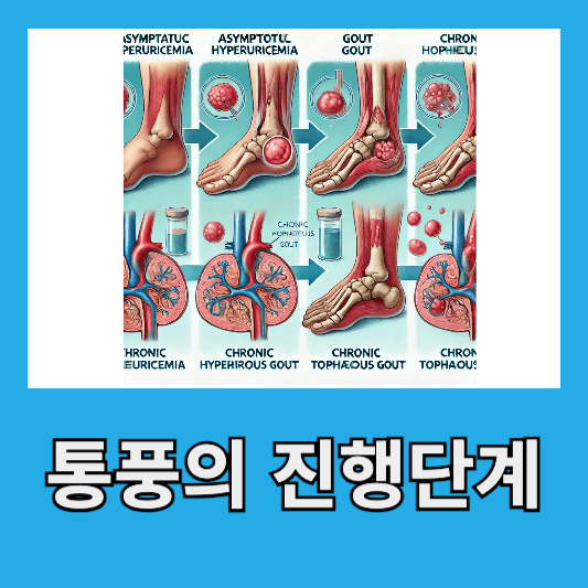 통풍의 증상과 단계별 진행